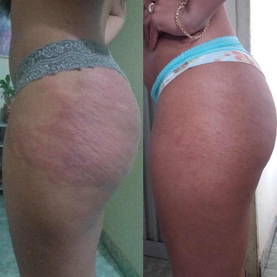 Tratamiento Endermo Prime para estrías